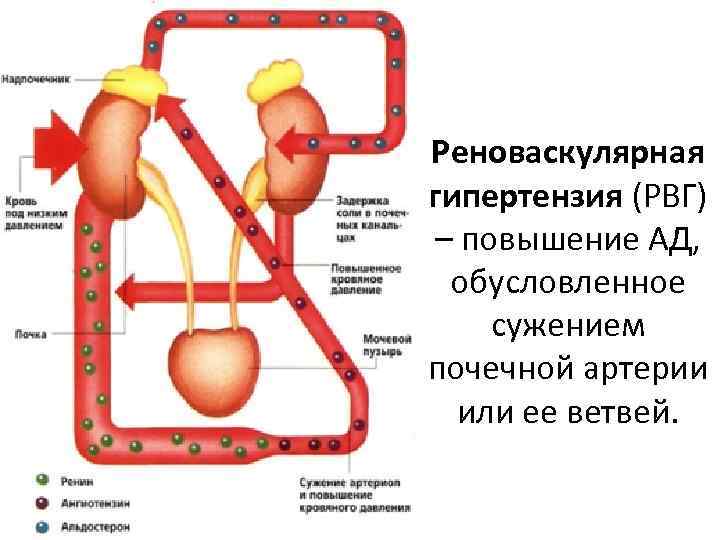 Реноваскулярная гипертензия (РВГ) – повышение АД, обусловленное сужением почечной артерии или ее ветвей. 