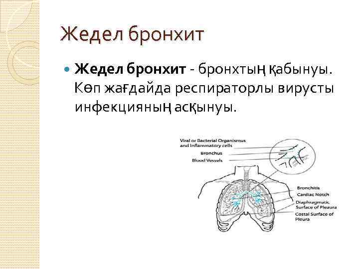 Жедел бронхит - бронхтың қабынуы. Көп жағдайда респираторлы вирусты инфекцияның асқынуы. 