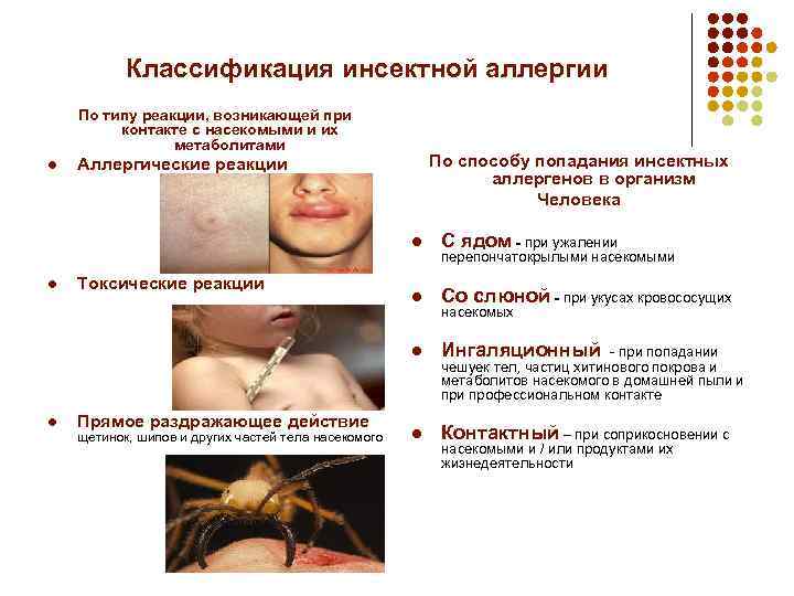 Классификация инсектной аллергии По типу реакции, возникающей при контакте с насекомыми и их метаболитами