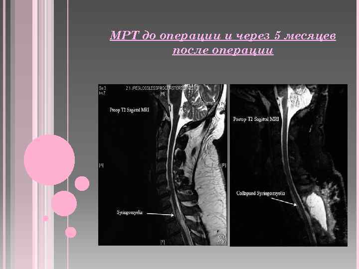 МРТ до операции и через 5 месяцев после операции 