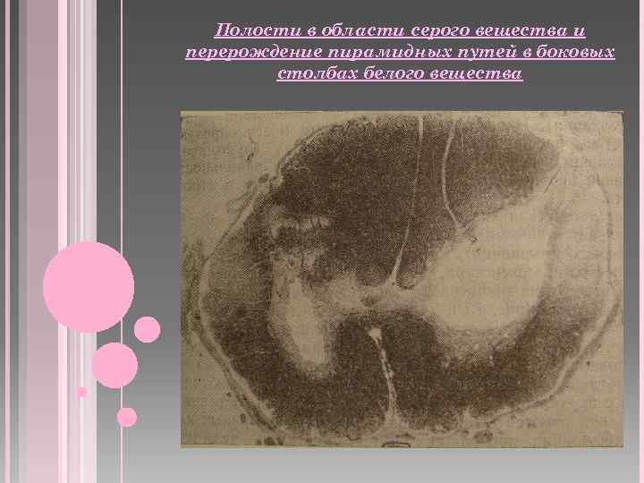 Полости в области серого вещества и перерождение пирамидных путей в боковых столбах белого вещества