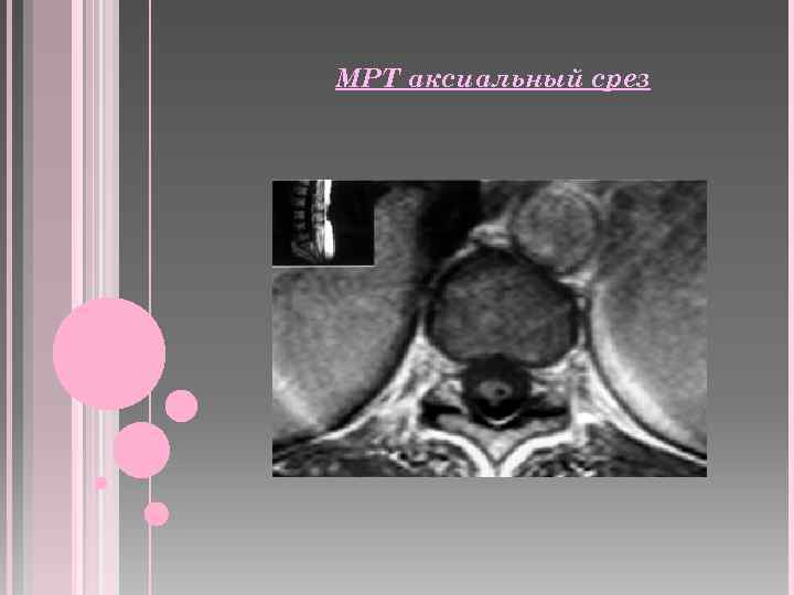 МРТ аксиальный срез 