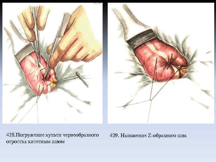 428. Погружение культи червеобразного отростка кисетным швом 429. Наложение Z-образного шва 