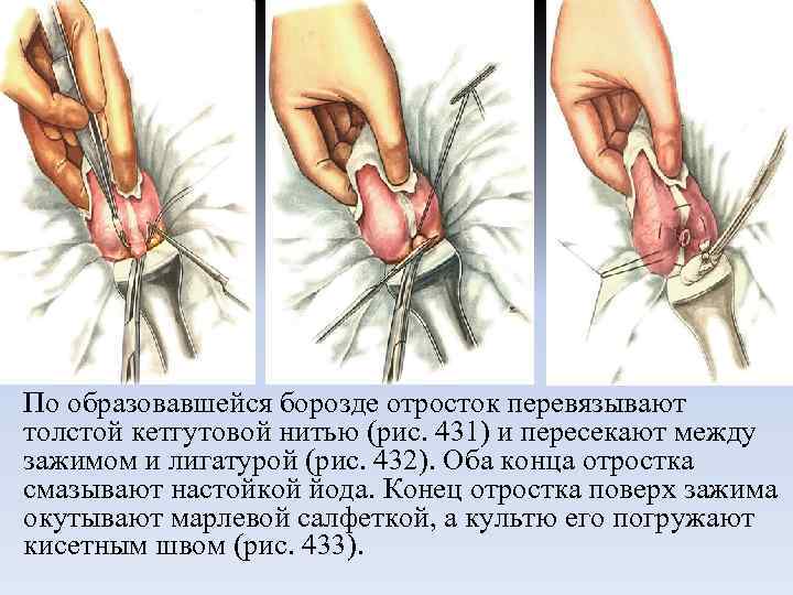 По образовавшейся борозде отросток перевязывают толстой кетгутовой нитью (рис. 431) и пересекают между зажимом