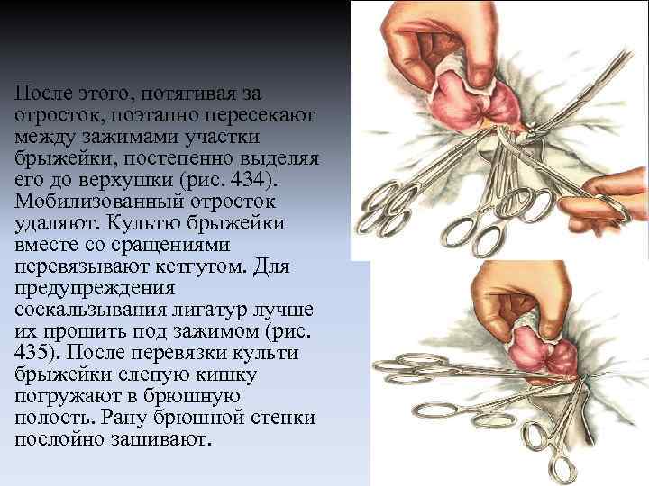 После этого, потягивая за отросток, поэтапно пересекают между зажимами участки брыжейки, постепенно выделяя его