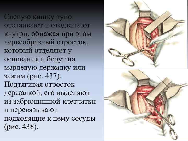 Слепую кишку тупо отслаивают и отодвигают кнутри, обнажая при этом червеобразный отросток, который отделяют
