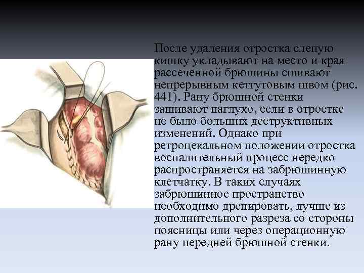После удаления отростка слепую кишку укладывают на место и края рассеченной брюшины сшивают непрерывным