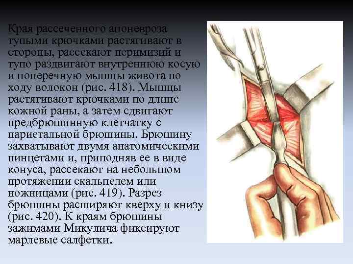 Края рассеченного апоневроза тупыми крючками растягивают в стороны, рассекают перимизий и тупо раздвигают внутреннюю