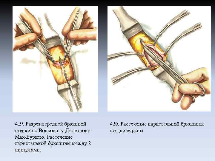 419. Разрез передней брюшной стенки по Волковичу-Дьяконову. Мак-Бурнею. Рассечение париетальной брюшины между 2 пинцетами.