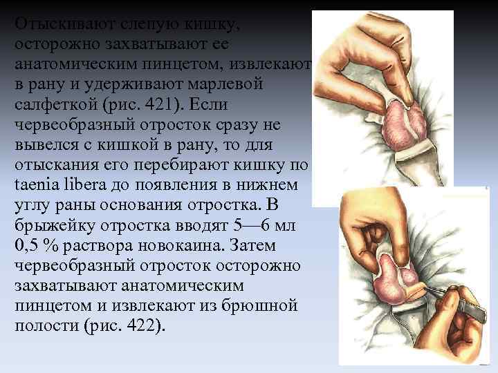 Отыскивают слепую кишку, осторожно захватывают ее анатомическим пинцетом, извлекают в рану и удерживают марлевой