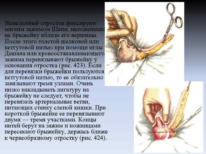 Выведенный отросток фиксируют мягким зажимом Шапи, наложенным на брыжейку вблизи его вершины. После этого