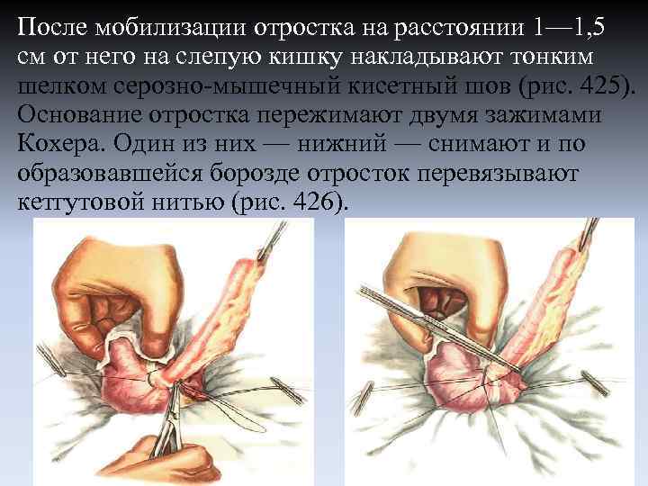 После мобилизации отростка на расстоянии 1— 1, 5 см от него на слепую кишку