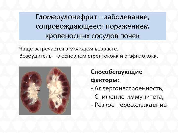 Гломерулонефрит – заболевание, сопровождающееся поражением кровеносных сосудов почек Чаще встречается в молодом возрасте. Возбудитель