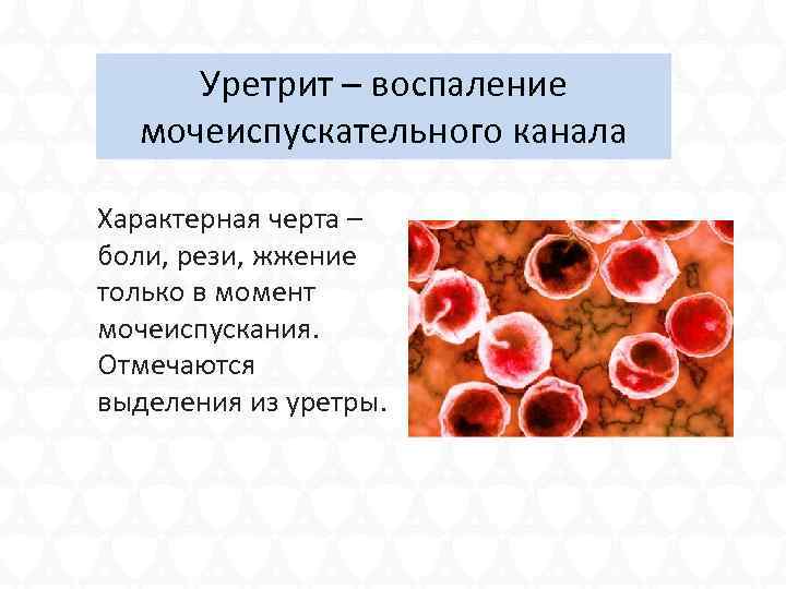 Уретрит – воспаление мочеиспускательного канала Характерная черта – боли, рези, жжение только в момент