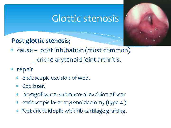 Glottic stenosis Post glottic stenosis; cause – post intubation (most common) _ cricho arytenoid