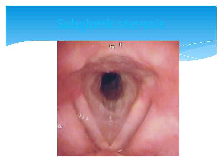 Subglottic stenosis 