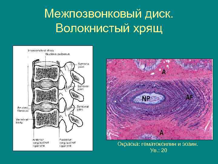 Субплевральный узел незрелой хрящевой ткани