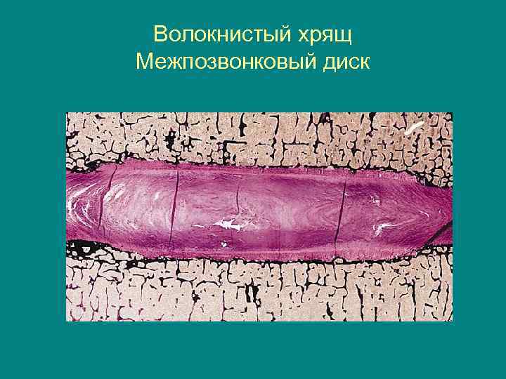 Волокнистый хрящ Межпозвонковый диск 