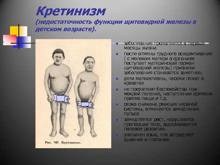 Кретинизм (недостаточность функции щитовидной железы в детском возрасте). n n n n заболевание проявляется