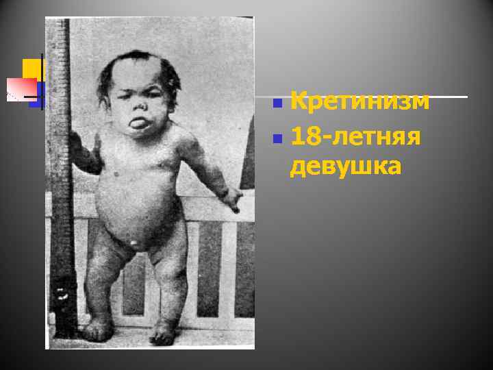 Кретинизм n 18 -летняя девушка n 