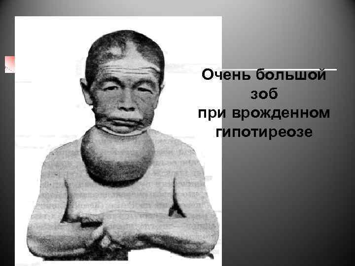 Очень большой зоб при врожденном гипотиреозе 