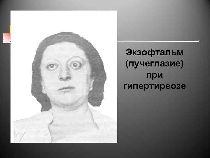 Экзофтальм (пучеглазие) при гипертиреозе 
