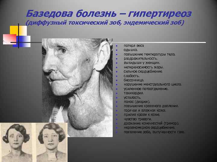 Базедова болезнь – гипертиреоз (диффузный токсический зоб, эндемический зоб) n n n n n
