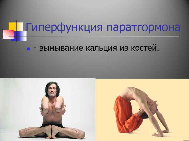 Гиперфункция паратгормона n - вымывание кальция из костей. 