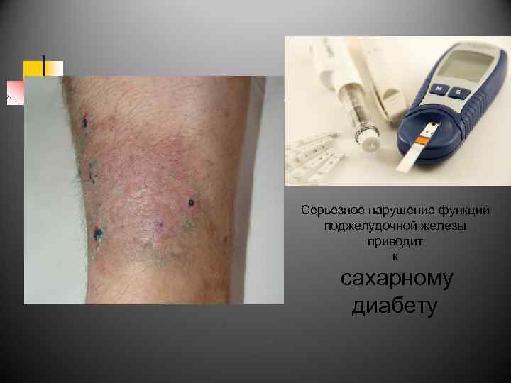 Серьезное нарушение функций поджелудочной железы приводит к сахарному диабету 