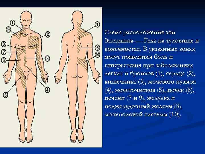 Схема расположения зон Захарьина — Геда на туловище и конечностях. В указанных зонах могут