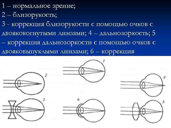 1 – нормальное зрение; 2 – близорукость; 3 - коррекция близорукости с помощью очков