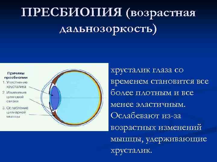 ПРЕСБИОПИЯ (возрастная дальнозоркость) хрусталик глаза со временем становится все более плотным и все менее
