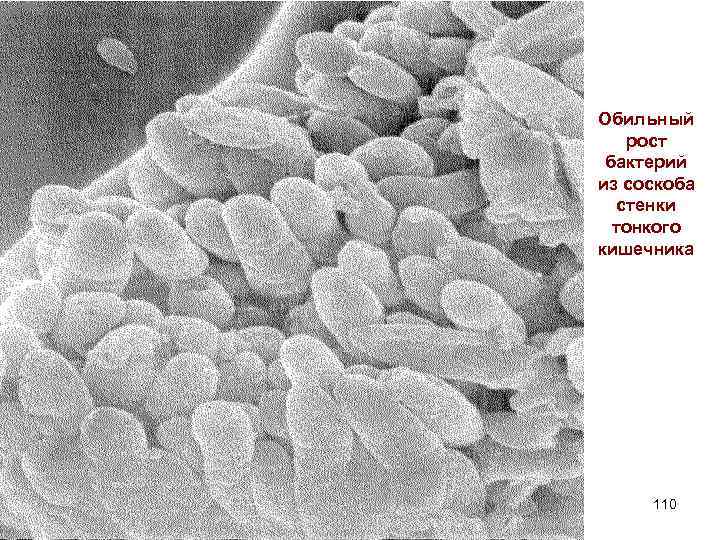 Обильный рост бактерий из соскоба стенки тонкого кишечника 110 