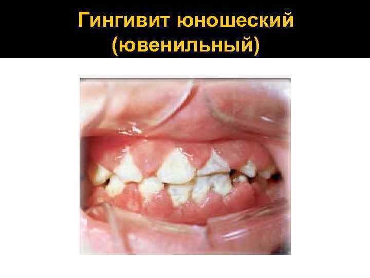 Гингивит юношеский (ювенильный) 