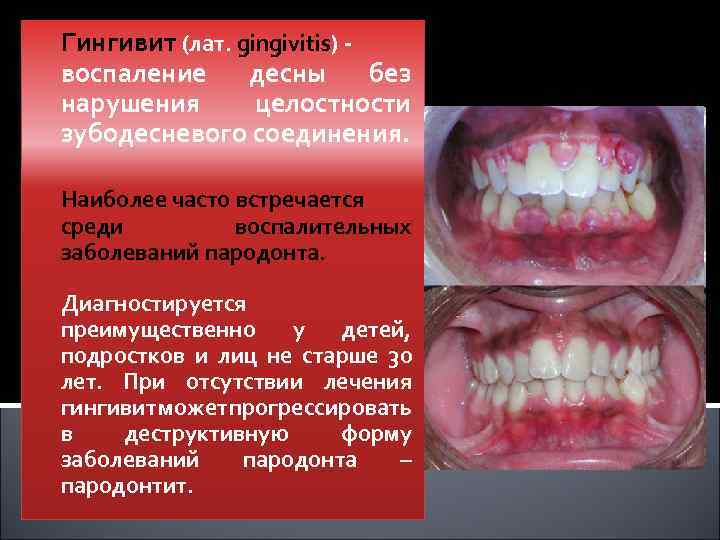 Пародонтит и гингивит презентация