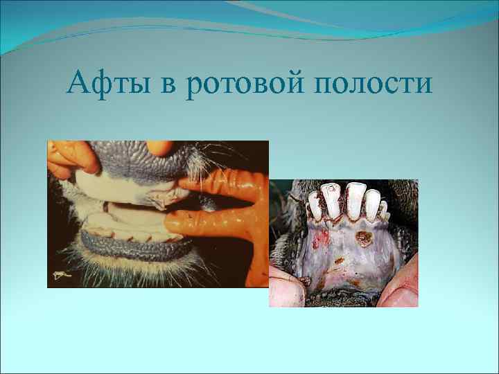 Афты в ротовой полости 