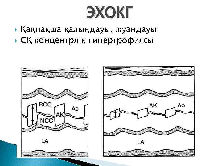 ЭХОКГ Қақпақша қалыңдауы, жуандауы СҚ концентрлік гипертрофиясы 