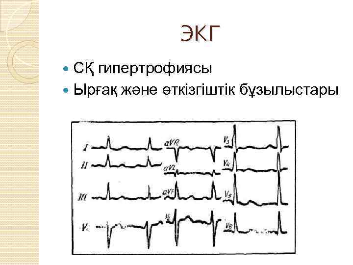 ЭКГ СҚ гипертрофиясы Ырғақ және өткізгіштік бұзылыстары 