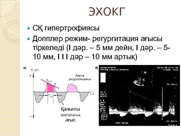 ЭХОКГ СҚ гипертрофиясы Допплер режим- регургитация ағысы тіркеледі (I дәр. – 5 мм дейн,