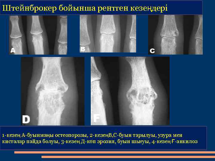 Штейнброкер бойынша рентген кезеңдері 1 -кезең А-буынмаңы остеопорозы, 2 -кезеңВ, С-буын тарылуы, узура мен