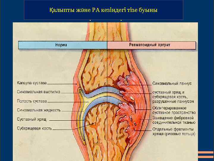 Қалыпты және РА кезіндегі тізе буыны 