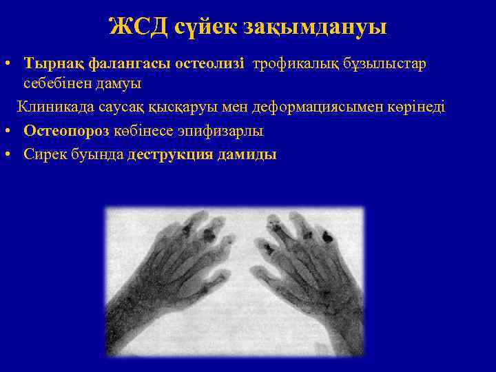 ЖСД сүйек зақымдануы • Тырнақ фалангасы остеолизі трофикалық бұзылыстар себебінен дамуы Клиникада саусақ қысқаруы