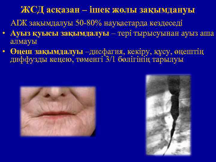 ЖСД асқазан – ішек жолы зақымдануы АІЖ зақымдалуы 50 -80% науқастарда кездеседі • Ауыз