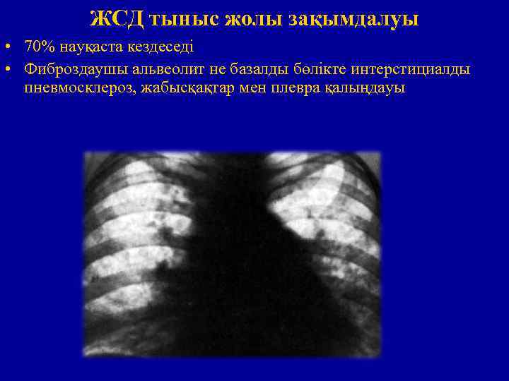 ЖСД тыныс жолы зақымдалуы • 70% науқаста кездеседі • Фиброздаушы альвеолит не базалды бөлікте