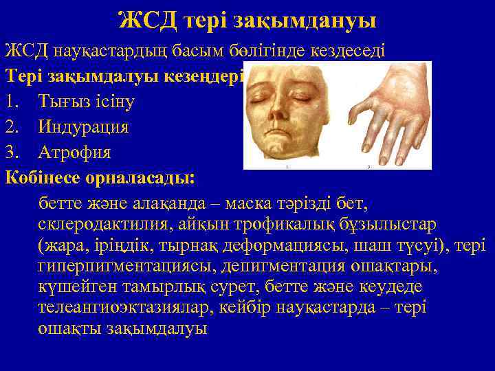 ЖСД тері зақымдануы ЖСД науқастардың басым бөлігінде кездеседі Тері зақымдалуы кезеңдері: 1. Тығыз ісіну