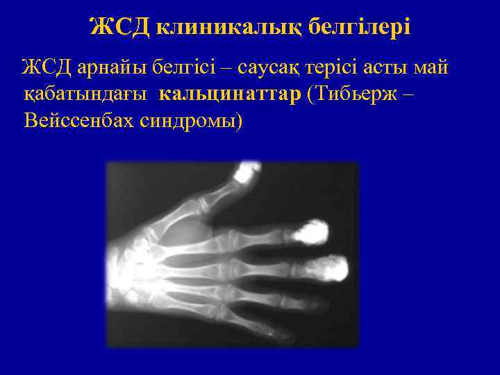 ЖСД клиникалық белгілері ЖСД арнайы белгісі – саусақ терісі асты май қабатындағы кальцинаттар (Тибьерж
