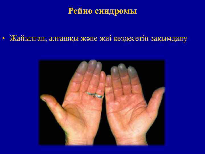 Рейно синдромы • Жайылған, алғашқы және жиі кездесетін зақымдану 