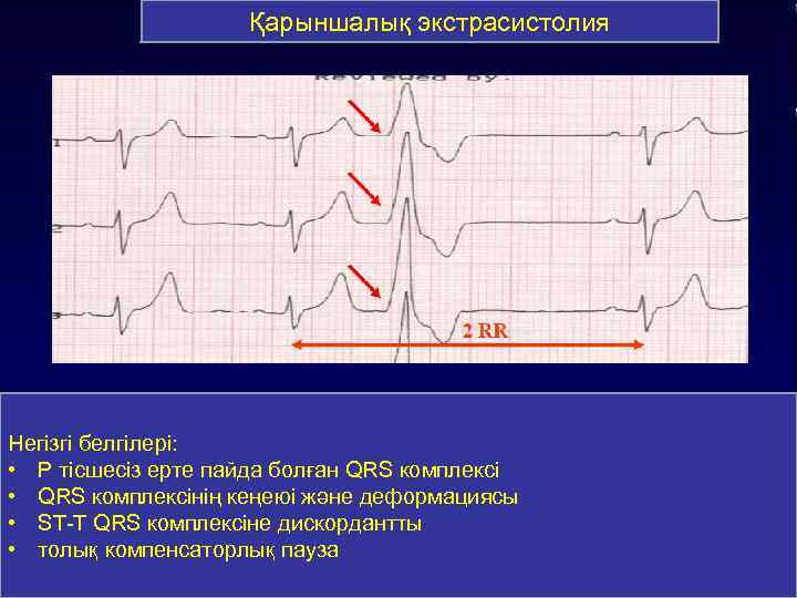 Қарыншалық экстрасистолия Негізгі белгілері: • Р тісшесіз ерте пайда болған QRS комплексі • QRS