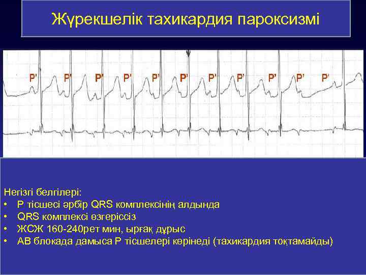 Жүрекшелік тахикардия пароксизмі Негізгі белгілері: • Р тісшесі әрбір QRS комплексінің алдында • QRS