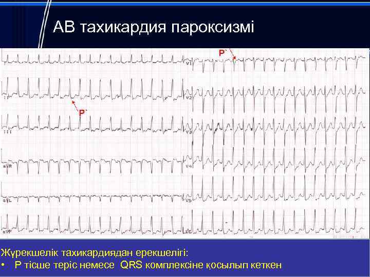 АВ тахикардия пароксизмі Жүрекшелік тахикардиядан ерекшелігі: • Р тісше теріс немесе QRS комплексіне қосылып